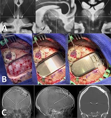 Responsive Neurostimulation of the Thalamus for the Treatment of Refractory Epilepsy